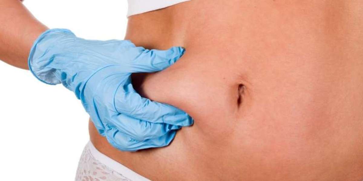 Liposuction Before and After: What to Expect from the Procedure