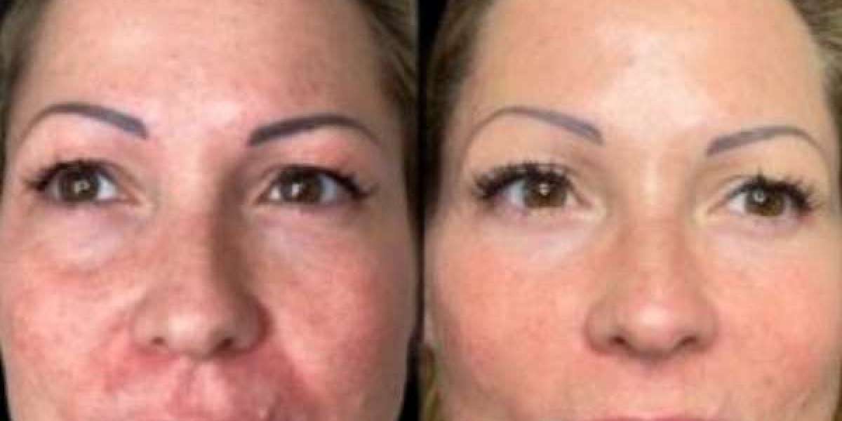 Ignite Renewal through Profhilo with the Best Plastic Surgeons in dubai