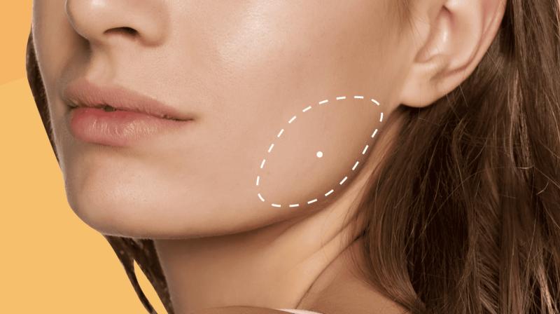 Masseter Filler vs. Botox - What is the Difference?