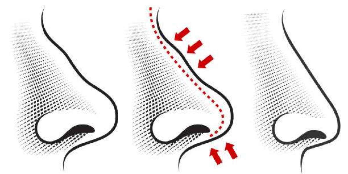 Leading Facial Plastic Surgeons for Rhinoplasty in Islamabad