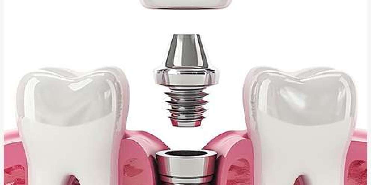 Có nên trồng răng implant không? Giải pháp phục hình tối ưu cho răng mất