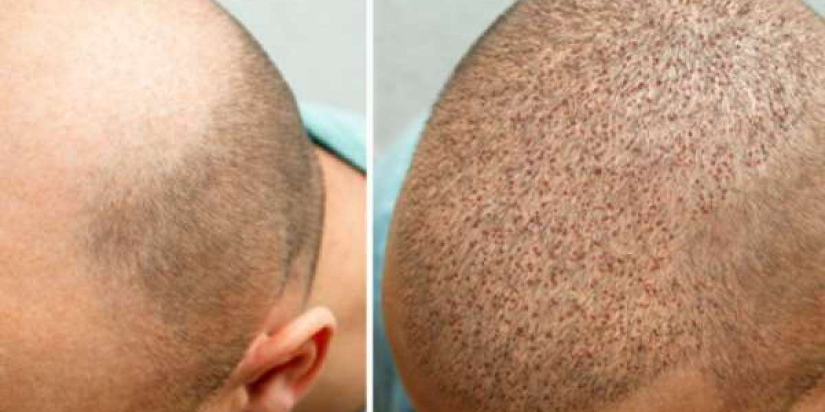 Hair Transplant in Islamabad: The Complete Guide to Natural Hair Restoration