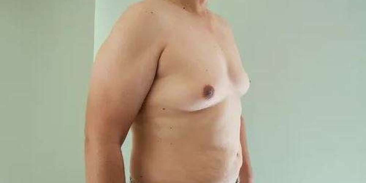 A Comprehensive Guide to Gynaecomastia Treatment in 2025
