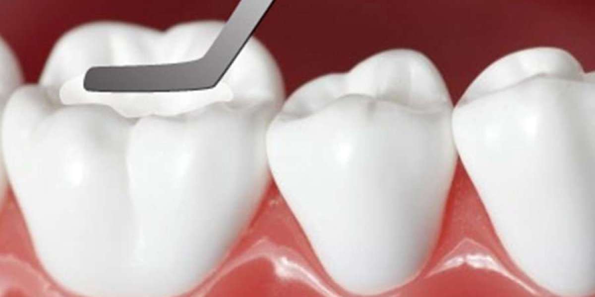Trám răng là gì? Cập nhật kiến thức nha khoa chuẩn xác và dễ hiểu