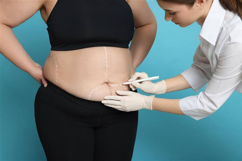 Bariatric Surgery and Skin Changes: What to Expect and Available Treatments - DFW Bariatrics and General Surgery