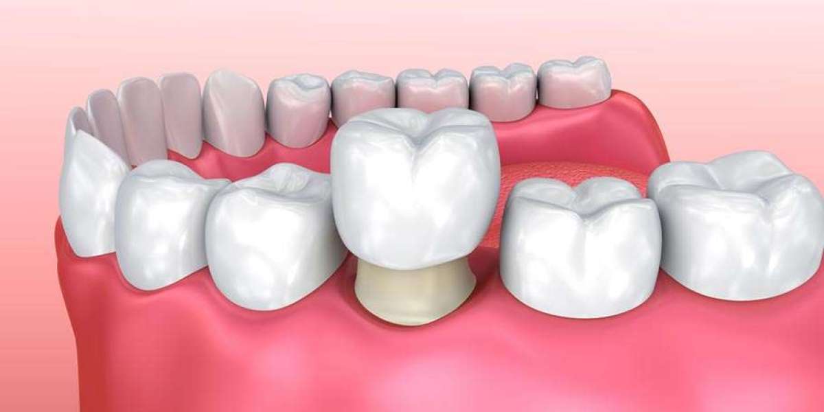 Răng bọc sứ là gì? Giải pháp thẩm mỹ và phục hồi răng toàn diện