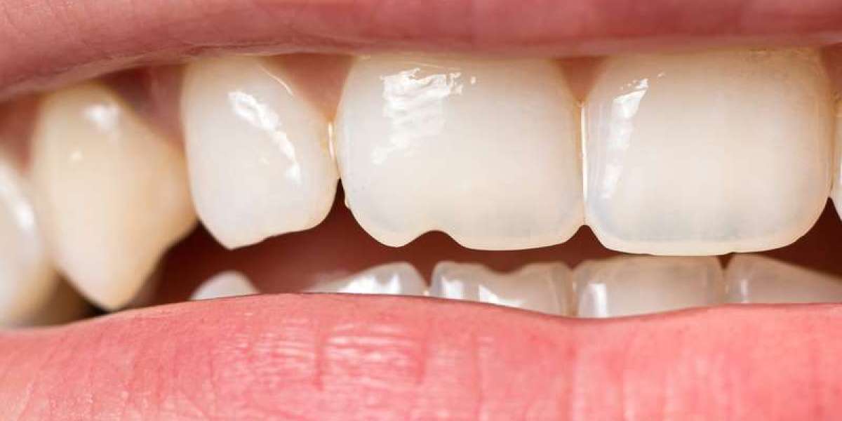 Bọc răng sứ là gì? Hiểu đúng để chọn đúng