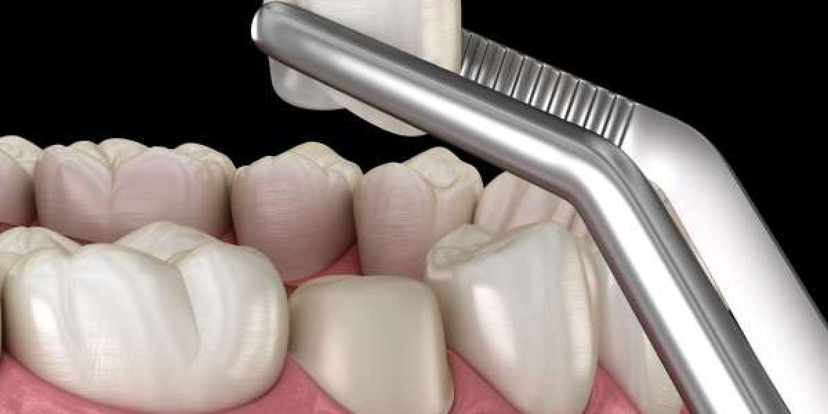 Quy Trình Bọc Răng Sứ Cho Răng Sâu: Các Bước, Lợi Ích Và Những Điều Cần Biết