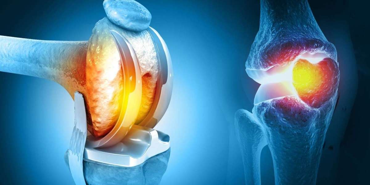 Enjoy Better Function After Knee Replacement Surgery
