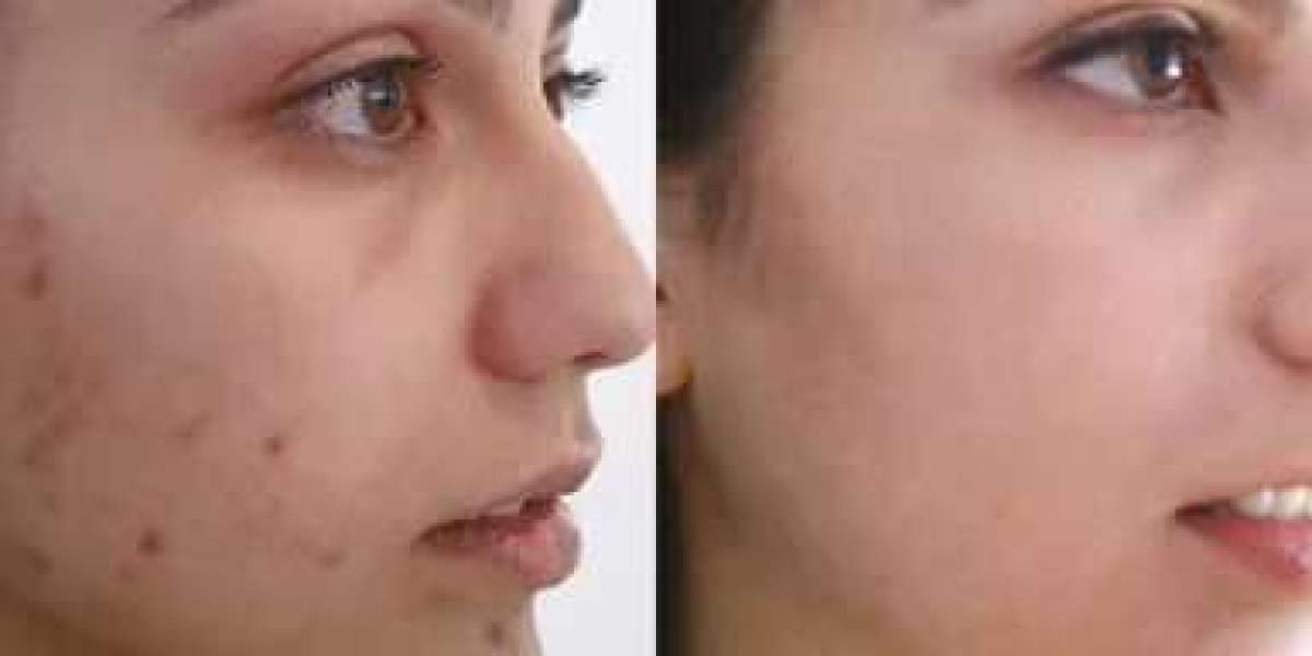 Effective Acne Treatment and Mole Removal in Itasca: