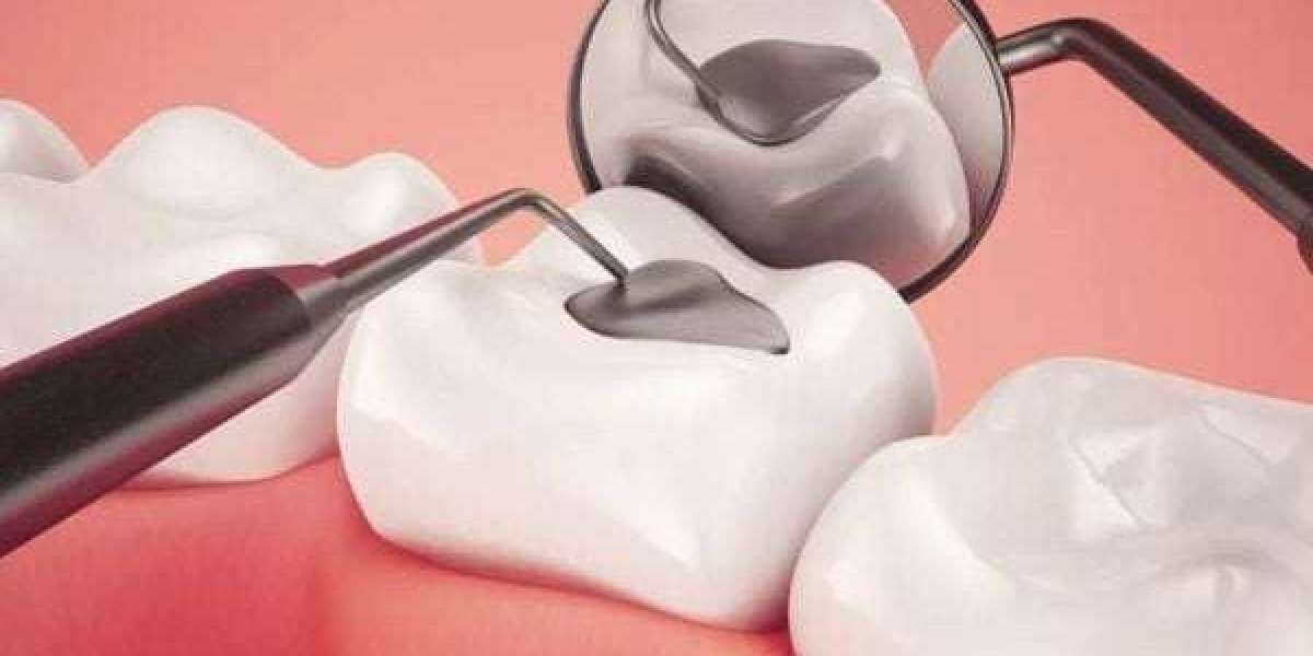 Răng bị sâu lỗ to có trám được không? Giải đáp từ chuyên gia