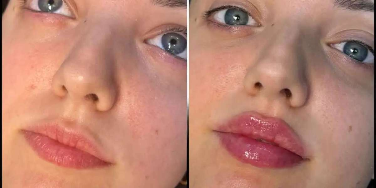 Best Plastic Surgeons in dubai on the Latest Fillers Innovations