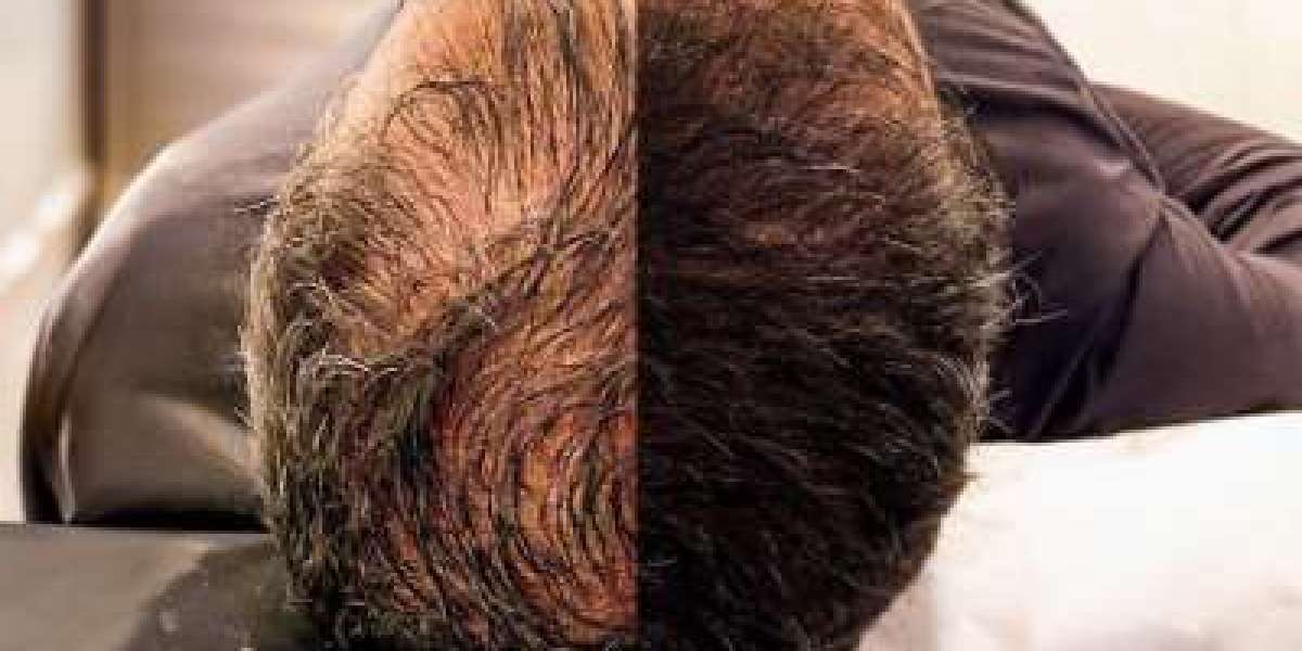 Why More People Are Choosing Hair Transplant in Islamabad