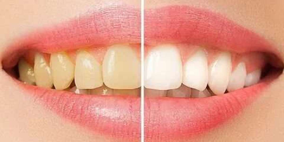 Teeth Cleaning and Polishing in Islamabad – Step by Step Guide