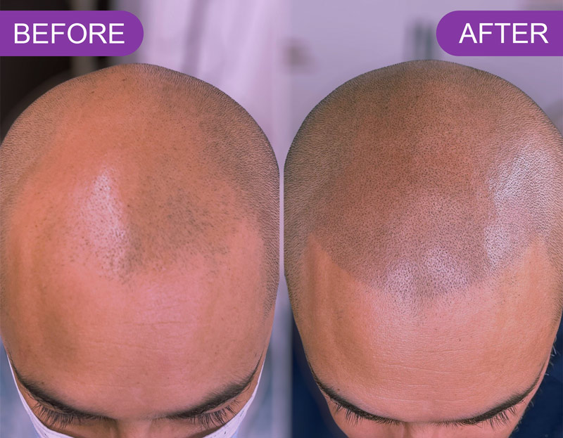 Scalp Micropigmentation: The Solution for Hair Loss in Kolkata