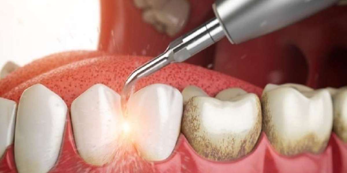Lấy cao răng có đau không? Sự thật phía sau nỗi lo phổ biến