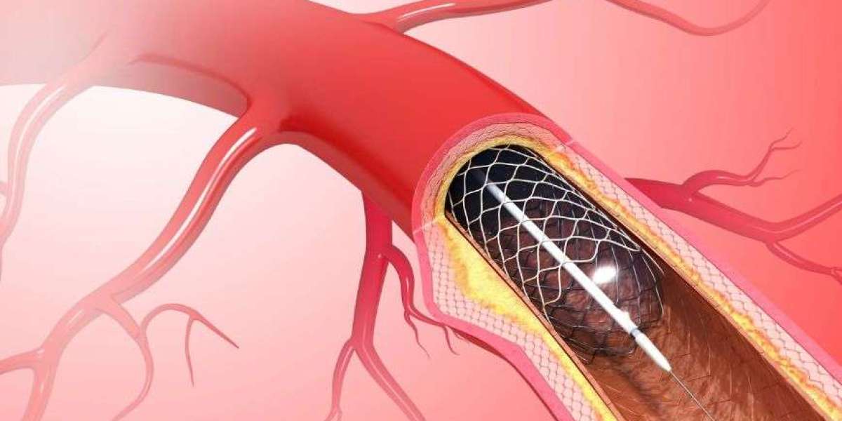 Cardiovascular Stents Market Size, Share & Analysis - 2034