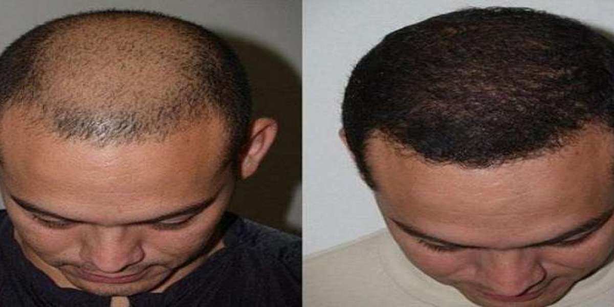 Dr. Naveed Hair Transplant – Are Results Truly Guaranteed?