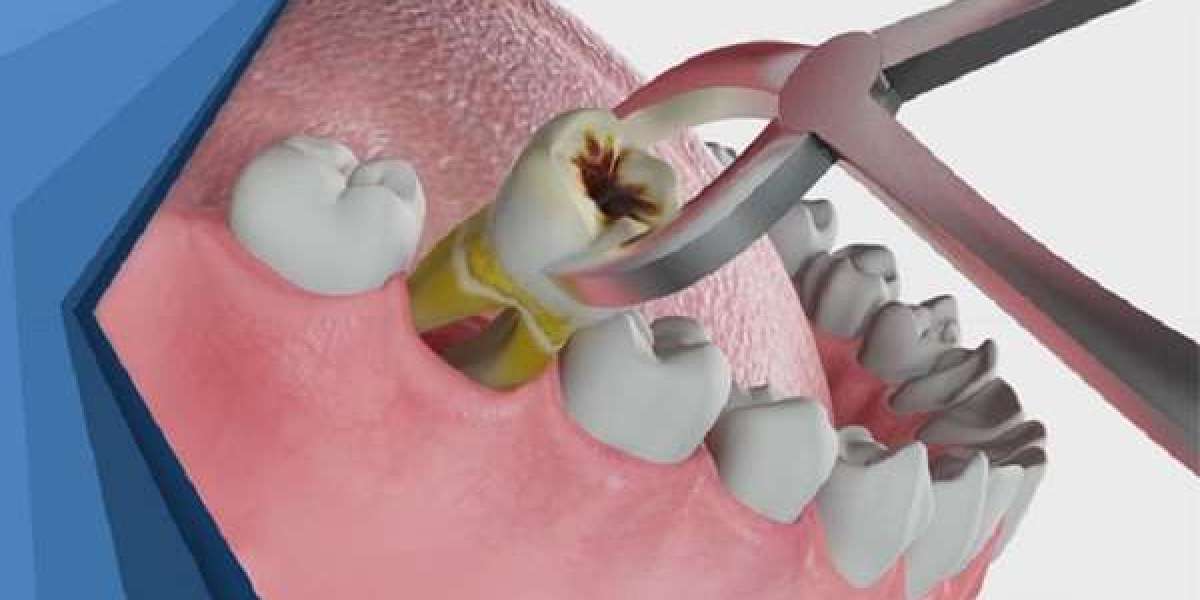 Vệ sinh răng miệng sau khi nhổ răng khôn đúng cách để tránh biến chứng