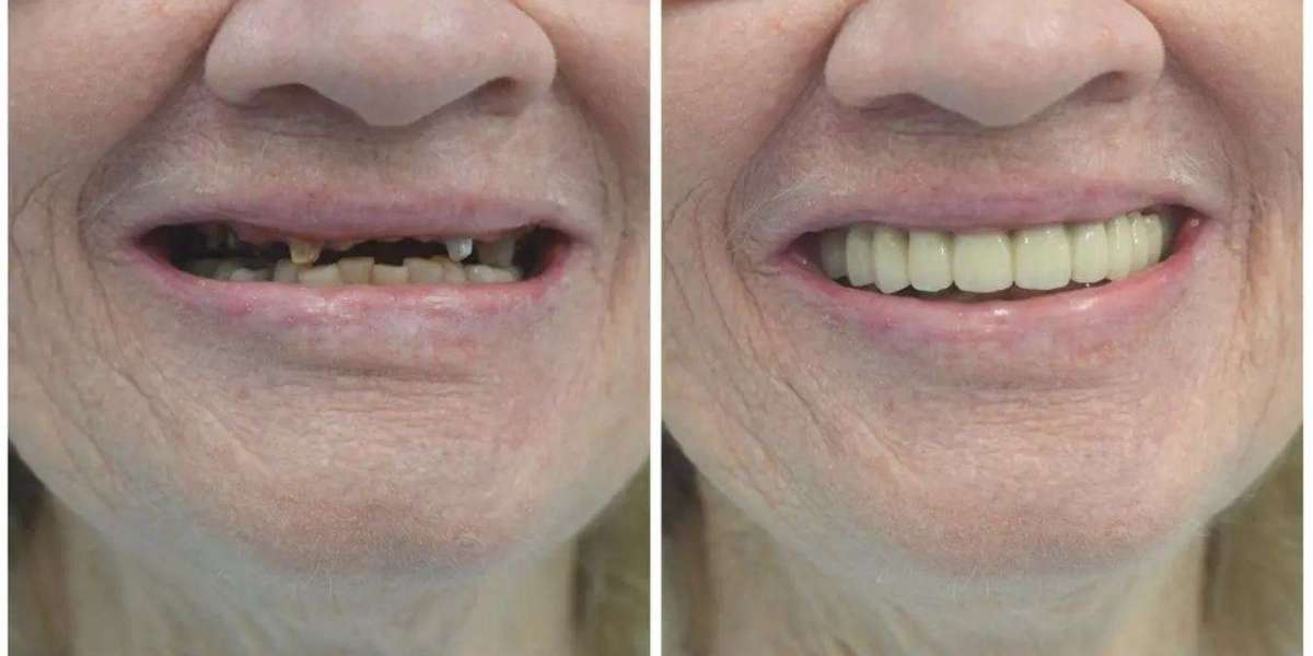 Restore Your Smile with Dental Crown Bridges