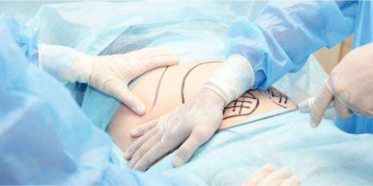 Tummy Tuck in Dubai – Flatten and Tone Your Abdomen