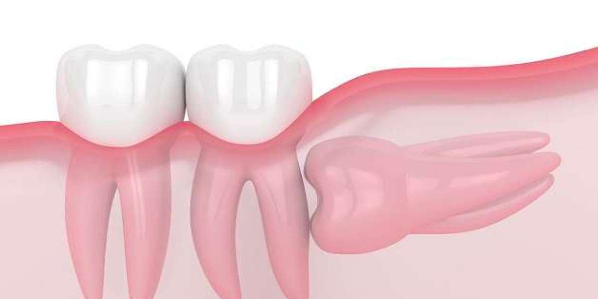 Trám răng composite: Giải pháp phục hồi răng sâu an toàn và thẩm mỹ