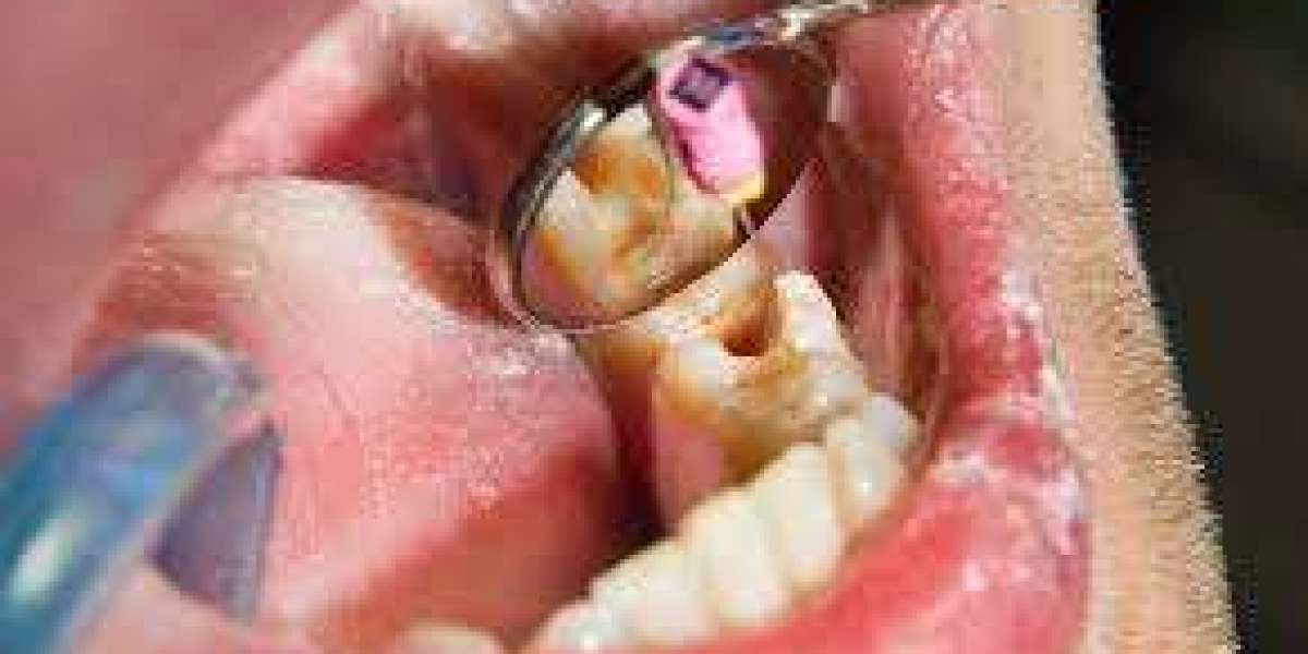 Root Canal Relief in Islamabad