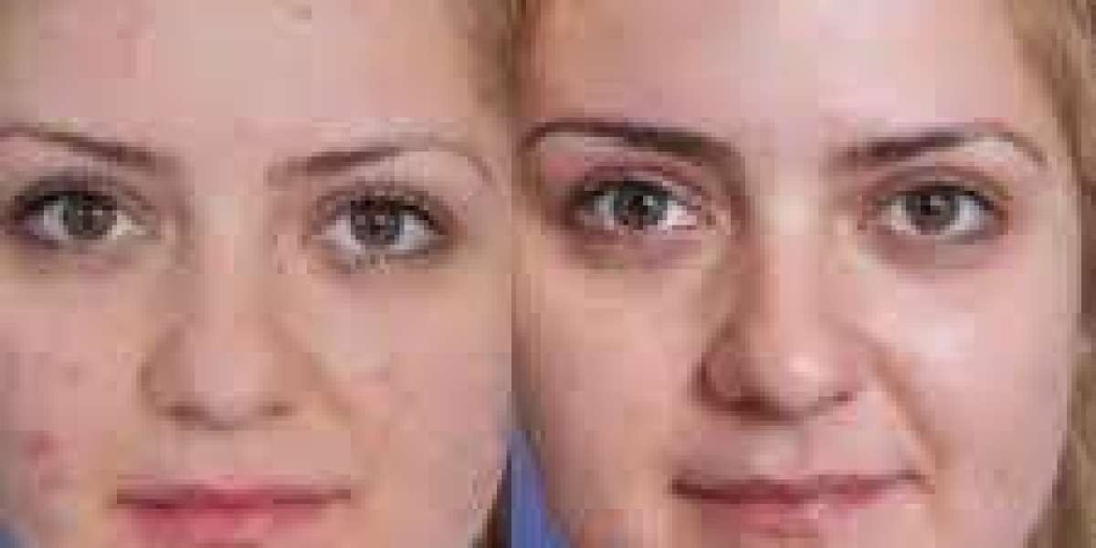 Microneedling Treatment in Islamabad – The Secret to Glowing Skin