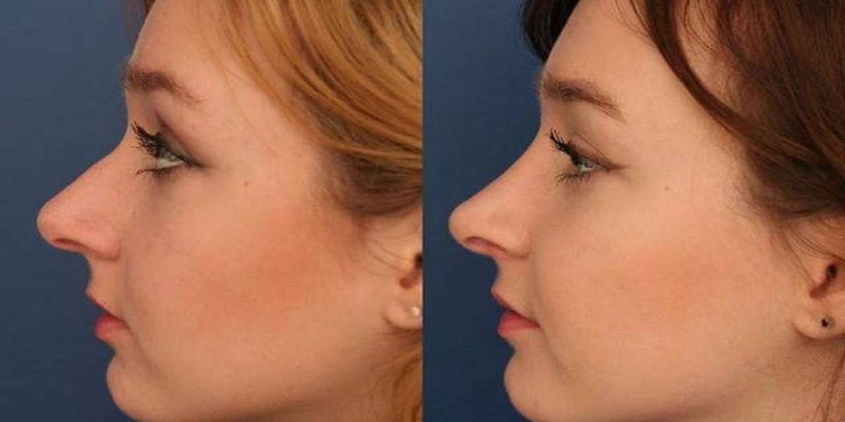 نصائح العناية بعد عملية تجميل الأنف من خبراء الرياض