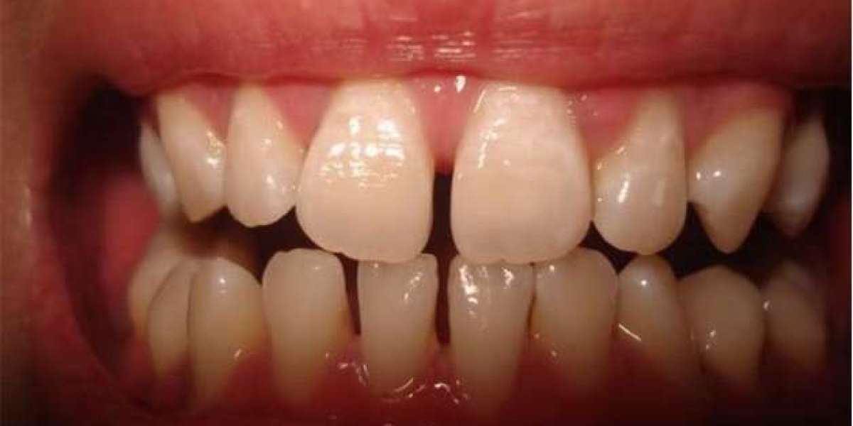 Trám răng bao lâu thì được ăn? Câu hỏi quan trọng sau điều trị bạn không nên bỏ qua