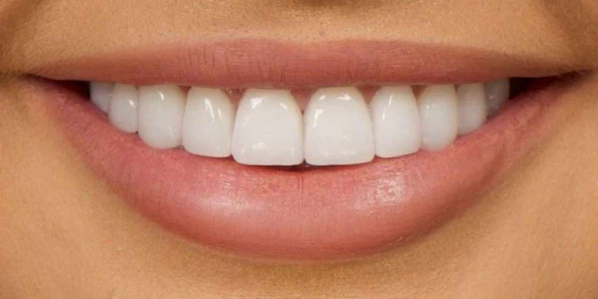 Dental Veneers Price in Islamabad