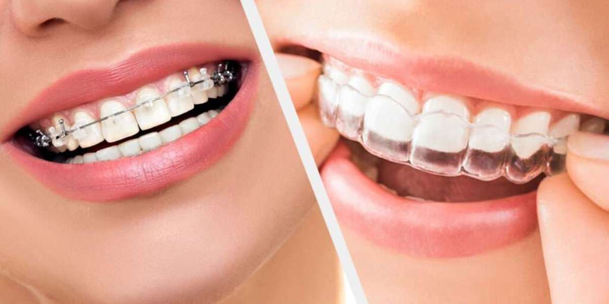 Exploring Teeth Aligners in Pakistan