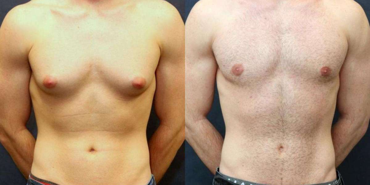 Transform Your Confidence with Gynecomastia Treatment in Islamabad