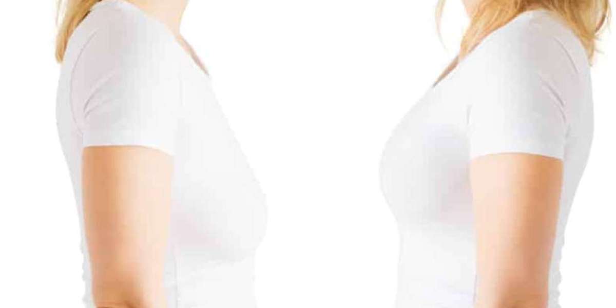 Choosing the Right Surgeon for Your Breast Lift Procedure