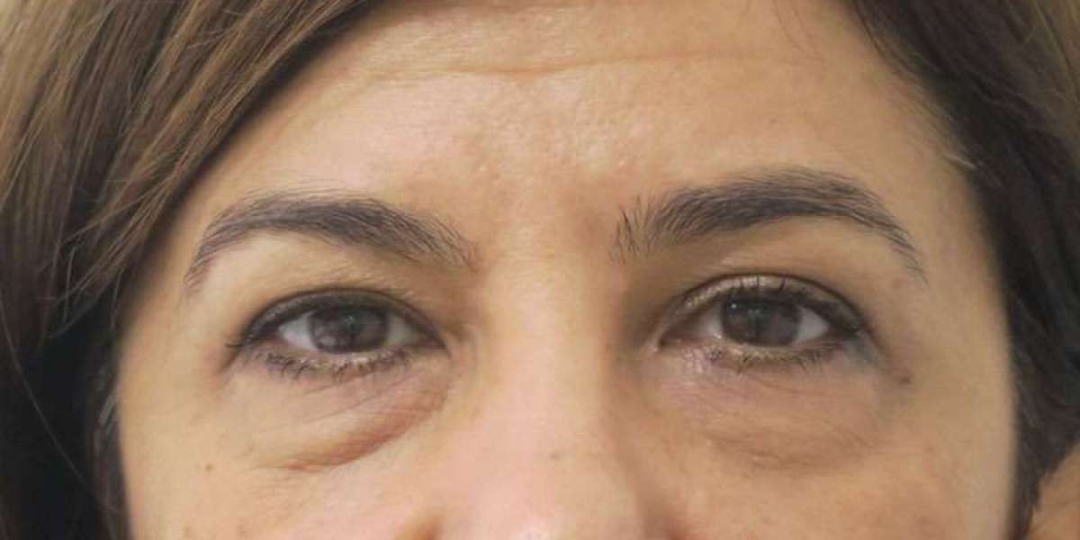 Rinoplastia en Madrid: Aumento de la Nariz con Injertos