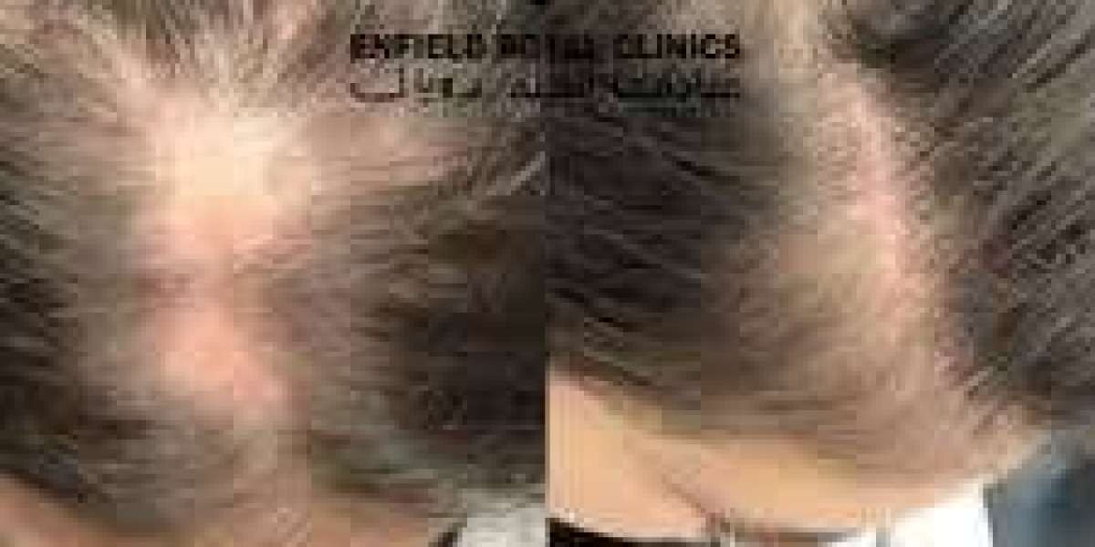 Alopecia Areata Treatment in Islamabad – Restore Hair with Confidence