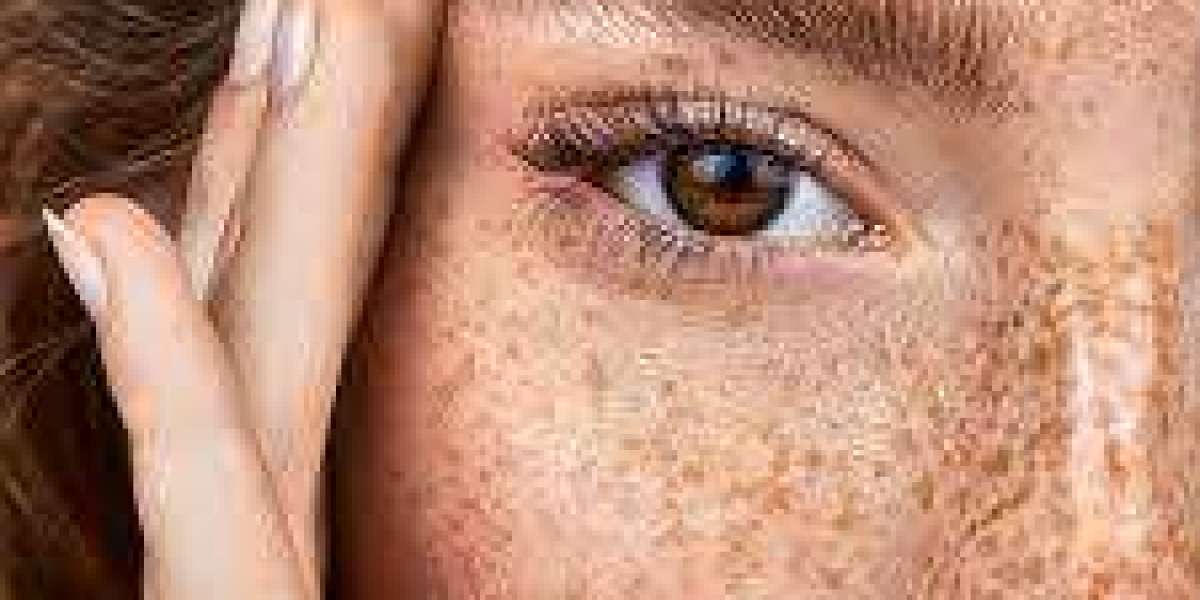 Finding the Right Melasma Doctor in Islamabad