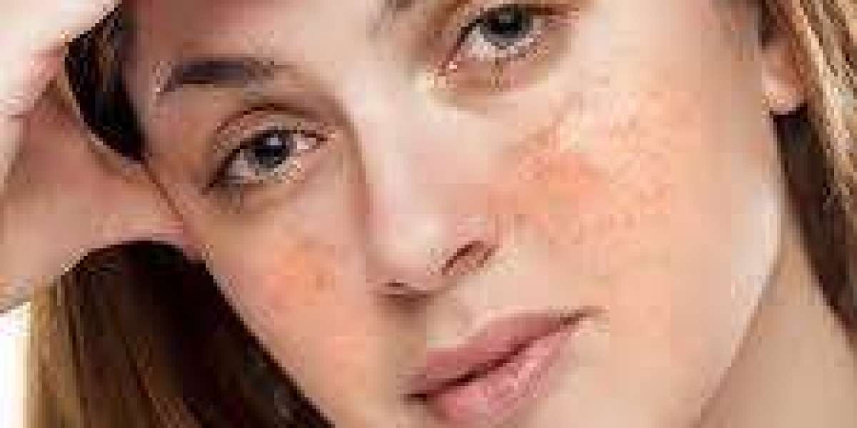 Melasma Treatment in Islamabad: Safe & Proven Solutions for Radiant Skin