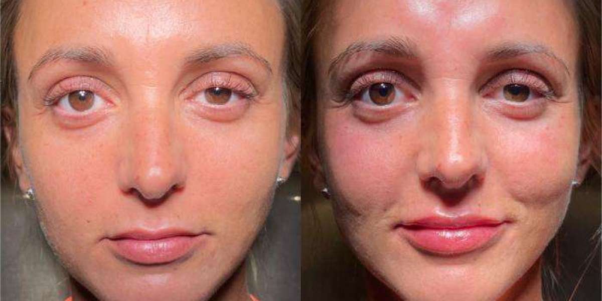 Restore Confidence with Dermal Fillers in Islamabad