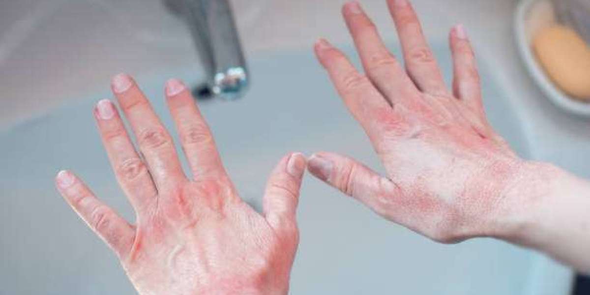 Trusted Allergy Doctor in Delhi for Personalized & Long-Term Allergy Relief