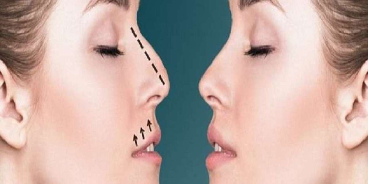 تجربتي الكاملة مع عملية تجميل الأنف في الرياض: يوميات وصور