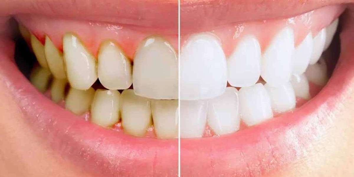 Lấy cao răng đúng cách: Giải pháp ngừa viêm nướu từ sớm