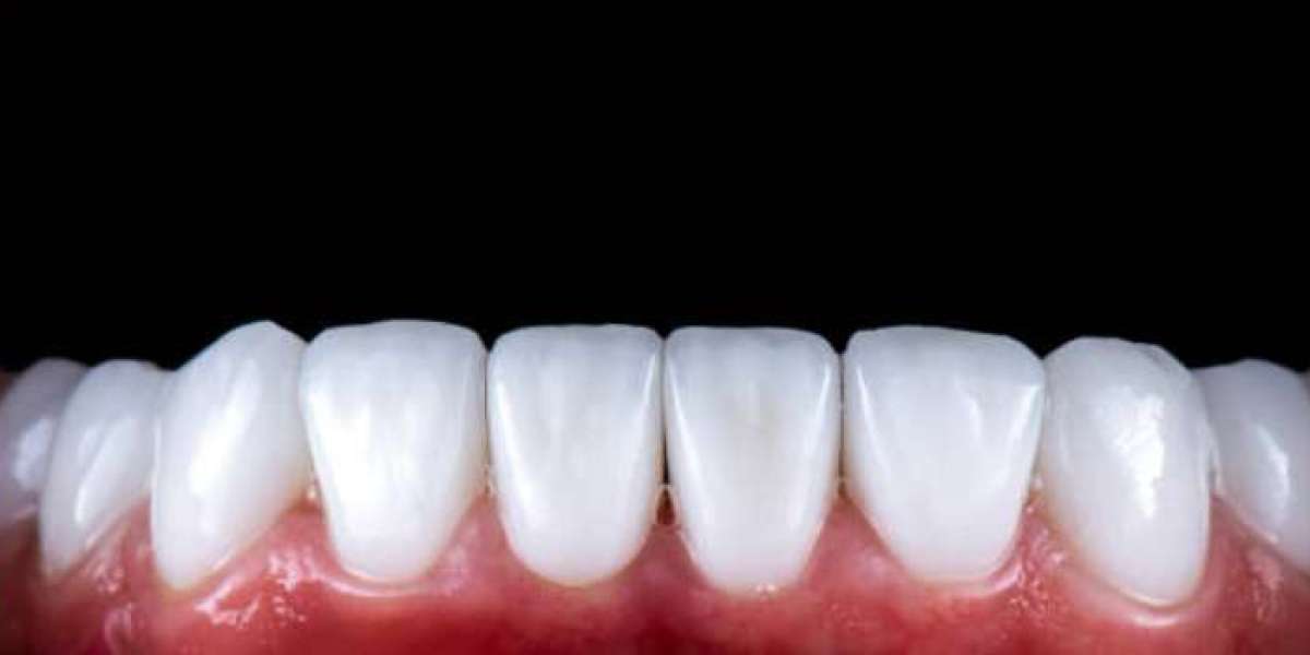 Why Composite Veneers Near Me Are a Great Alternative to Porcelain Veneers
