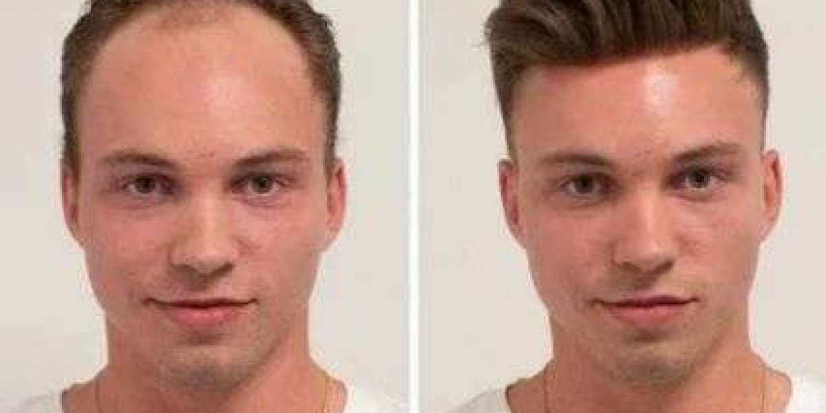 Best Hair Transplant in Islamabad: Your Path to Lasting Hair and Confidence