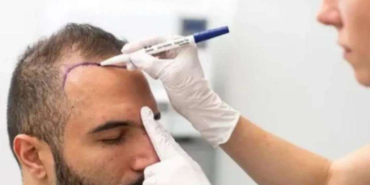 Hair Transplant in Karachi: A Complete Guide to Modern Techniques, Costs, and Results