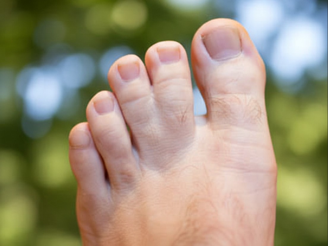 How Common Is Webbed Toes?