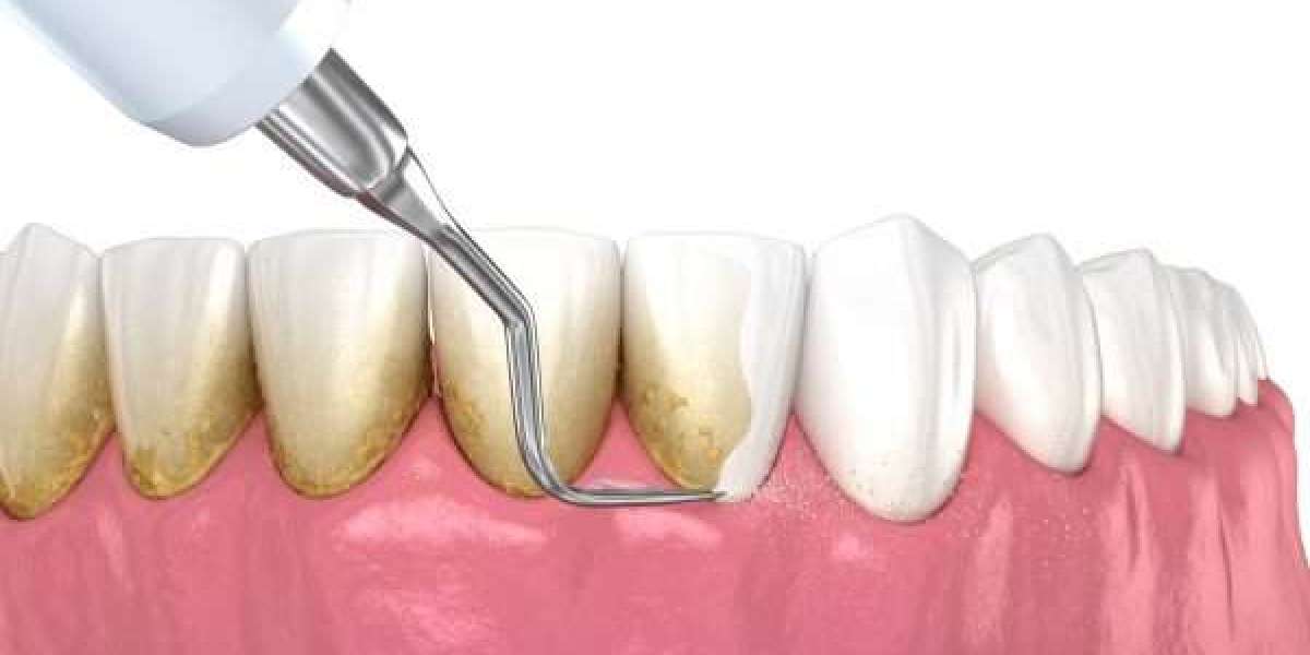 Lấy cao răng: Làm sạch sâu, bảo vệ nướu và ngăn viêm nhiễm răng miệng
