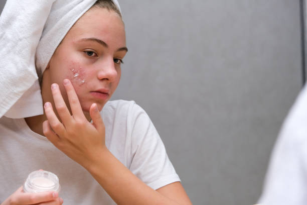 Cystic Acne Treatments in Paterson NJ to Target Deep Acne