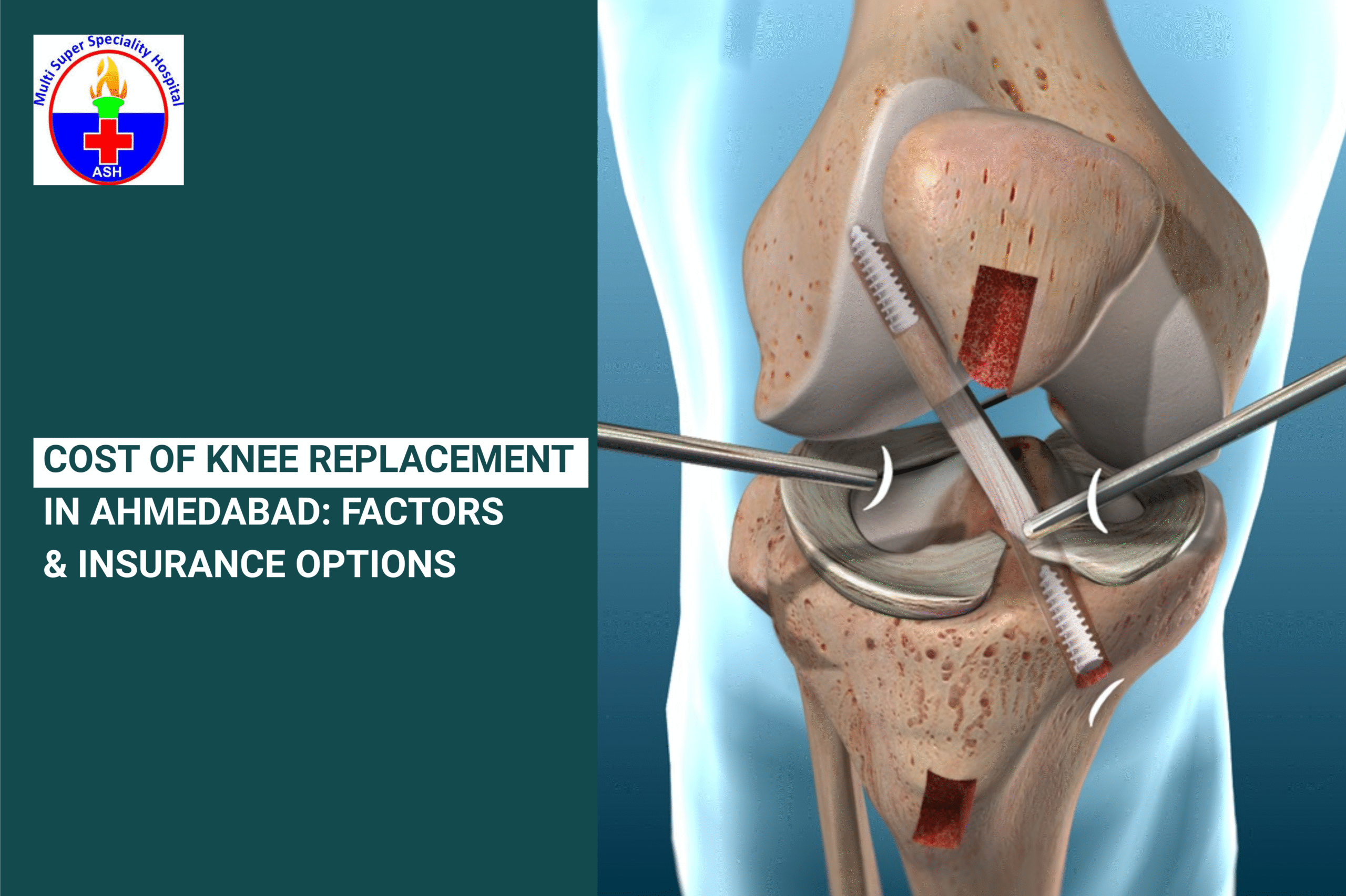 Knee Replacement Cost in Ahmedabad | Surgery + Insurance