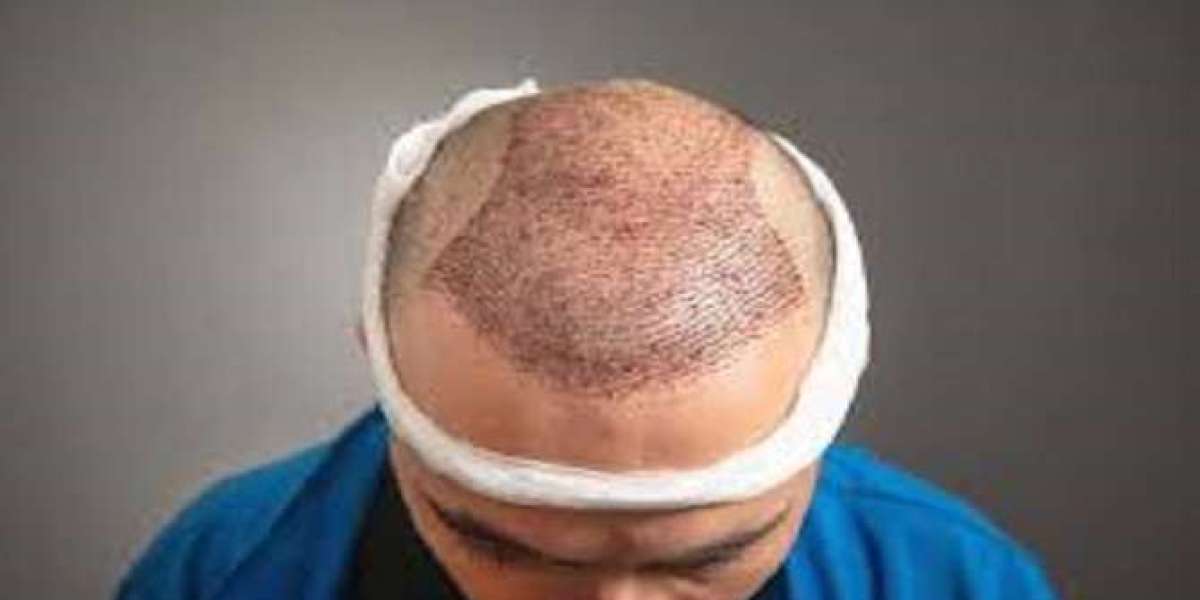 The Complete Guide to Hair Transplants in Riyadh
